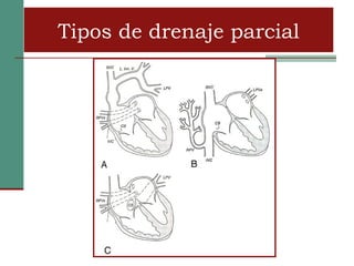 Tipos de drenaje parcial
 