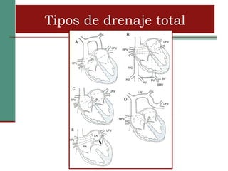 Tipos de drenaje total
 