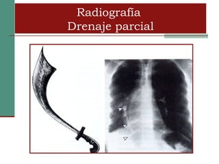 Radiografía
Drenaje parcial
 