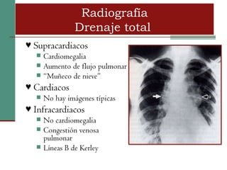 Radiografía
                 Drenaje total
♥ Supracardiacos
      Cardiomegalia
      Aumento de flujo pulmonar
      “Muñeco de nieve”
♥ Cardiacos
      No hay imágenes típicas
♥ Infracardiacos
      No cardiomegalia
      Congestión venosa
       pulmonar
      Líneas B de Kerley
 