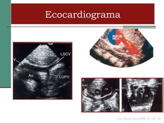 Ecocardiograma




             Ann Thorac Surg 2000;70:128 –30
 