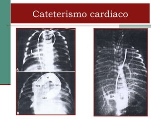 Cateterismo cardiaco
 