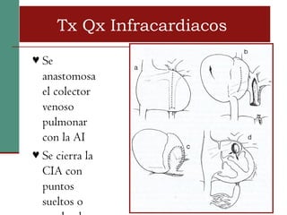 Tx Qx Infracardiacos
♥ Se
  anastomosa
  el colector
  venoso
  pulmonar
  con la AI
♥ Se cierra la
  CIA con
  puntos
  sueltos o
 