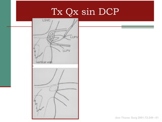 Tx Qx sin DCP




            Ann Thorac Surg 2001;72:249 –51
 