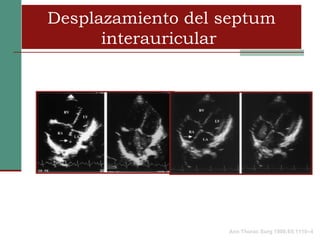 Desplazamiento del septum
      interauricular




                   Ann Thorac Surg 1998;65:1110–4
 