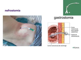 nefrostomia
 gastrostomia
 