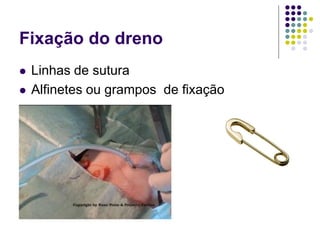 Fixação do dreno
 Linhas de sutura
 Alfinetes ou grampos de fixação
 
