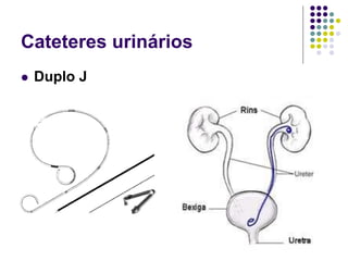 Cateteres urinários
 Duplo J
 