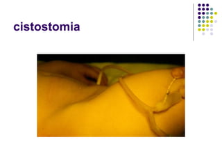 cistostomia
 