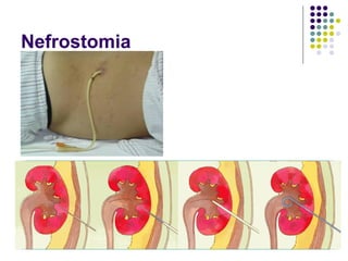 Nefrostomia
 