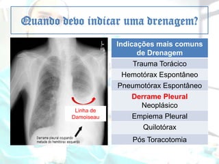 Quando devo indicar uma drenagem?
Indicações mais comuns
de Drenagem
Trauma Torácico
Hemotórax Espontâneo
Pneumotórax Espontâneo

Linha de
Damoiseau

Derrame Pleural
Neoplásico
Empiema Pleural

Quilotórax
Pós Toracotomia

 