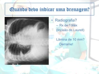 Quando devo indicar uma drenagem?
• Radiografia?
– Rx de Tórax
(Incisão de Laurell)
Lâmina de 10 mm?
Derrame!

 