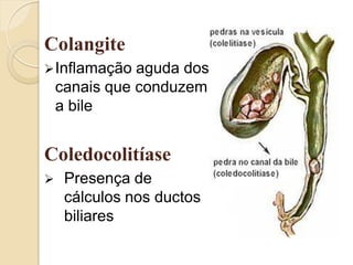 Colangite
 Inflamação   aguda dos
    canais que conduzem
    a bile


Coledocolitíase
    Presença de
     cálculos nos ductos
     biliares
 