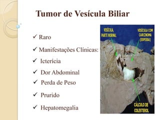 Tumor de Vesícula Biliar

 Raro

 Manifestações Clínicas:
 Icterícia
 Dor Abdominal
 Perda de Peso

 Prurido

 Hepatomegalia
 