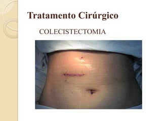 Tratamento Cirúrgico
  COLECISTECTOMIA
 