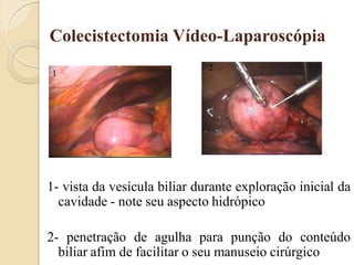 Colecistectomia Vídeo-Laparoscópia
                              2
1




1- vista da vesícula biliar durante exploração inicial da
  cavidade - note seu aspecto hidrópico

2- penetração de agulha para punção do conteúdo
  biliar afim de facilitar o seu manuseio cirúrgico
 