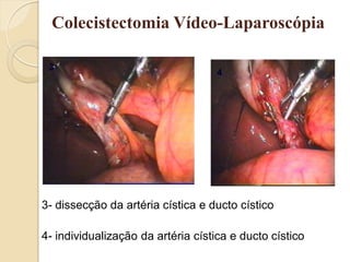 Colecistectomia Vídeo-Laparoscópia

 3
                                    4




3- dissecção da artéria cística e ducto cístico

4- individualização da artéria cística e ducto cístico
 