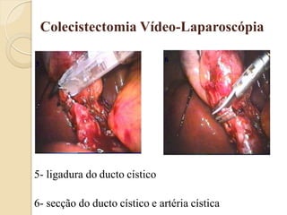Colecistectomia Vídeo-Laparoscópia

                               6
5




5- ligadura do ducto cístico

6- secção do ducto cístico e artéria cística
 