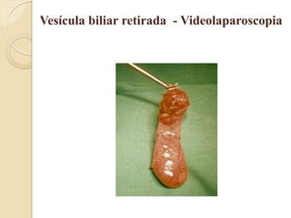 Vesícula biliar retirada - Videolaparoscopia
 