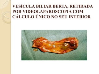 VESÍCULA BILIAR BERTA, RETIRADA
POR VIDEOLAPAROSCOPIA COM
CÁLCULO ÚNICO NO SEU INTERIOR
 