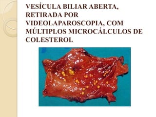 VESÍCULA BILIAR ABERTA,
RETIRADA POR
VIDEOLAPAROSCOPIA, COM
MÚLTIPLOS MICROCÁLCULOS DE
COLESTEROL
 