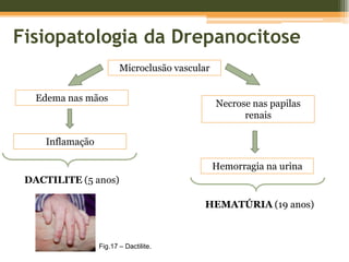 Fisiopatologia da DrepanocitoseLise e fagocitose de eritrócitos falciformes+Eritropoiese acelerada↑ consumo proteicoSíntese de Hb acelerada metabolitos de excreção proteicaInício de HIPOURÉMIA