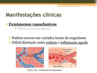 Fisiopatologia da DrepanocitoseElevada quantidade de eritrócitos sequestradosCRISES DE SEQUESTRAÇÃO+Crescimento esplénicoAcumulação de grande quantidade de sangue no baçoHipovolémiaChoque circulatório
