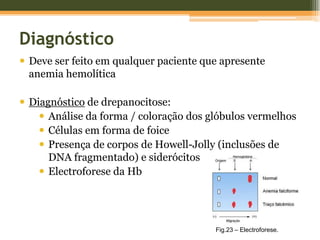 Fisiopatologia da DrepanocitoseMicroclusão vascularEdema nas mãosNecrose nas papilas renaisInflamaçãoHemorragia na urinaDACTILITE (5 anos)HEMATÚRIA (19 anos)Fig.17 – Dactilite.