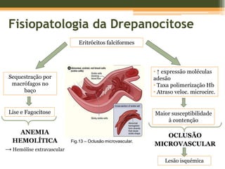 Trombospondina liga-se a glicano-sulfatosFig.12 – Interacção entre as células falciformes e o endotélio (1).