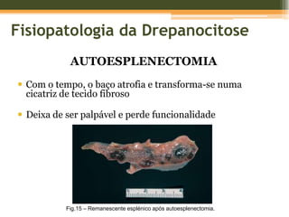  Atraso veloc. microcirc.Sequestração por macrófagos no baçoLise e FagocitoseMaior susceptibilidade à contençãoANEMIA HEMOLÍTICA-> Hemólise extravascularOCLUSÃO MICROVASCULARFig.13 – Oclusão microvascular.Lesão isquémica