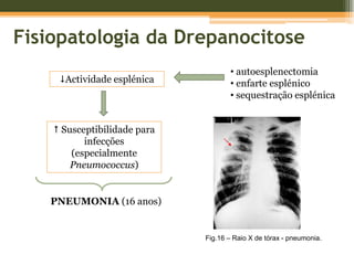 Fisiopatologia da DrepanocitoseInflamação (necrose tecidual)Libertação de mediadores inflamatórios↑ produção de leucócitos - leucocitose↑neutrófilos e eosinófilos–LEUCOCITOSE COM NEUTROFÍLIA E EOSINOFÍLIA↑adesão vascularOclusão microvascular