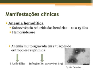 Fisiopatologia da DrepanocitoseAUTOESPLENECTOMIACom o tempo, o baço atrofia e transforma-se numa cicatriz de tecido fibroso