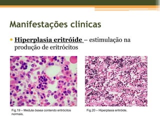 Deixa de ser palpável e perde funcionalidadeFig.15 – Remanescente esplénico após autoesplenectomia.