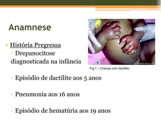 AnamneseHistória PregressaDrepanocitose diagnosticada na infânciaEpisódio de dactilite aos 5 anosPneumonia aos 16 anosEpisódio de hematúria aos 19 anosFig.1 – Criança com dactilite.