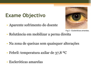 Exame ObjectivoAparente sofrimento do doenteRelutância em mobilizar a perna direitaNa zona de queixas sem quaisquer alteraçõesFebril: temperatura axilar de 37,8 ºCEscleróticas amarelasFig.2 – Escleróticas amarelas.