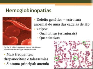 HemoglobinopatiasDefeito genético – estrutura anormal de uma das cadeias de Hb2 tipos:Qualitativas (estruturais)QuantitativasFig.5 e 6  – Morfologia das células falciformes (círculos verdes em 6) e não falciformes.Mais frequentes: drepanocitose e talassémiasSintoma principal: anemiaHemoglobinopatia HereditáriaDoença autossómica recessivaFig.7 – Transmissão hereditária da anemia falciforme.