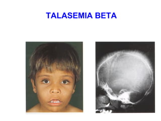 TALASEMIA BETA
 
