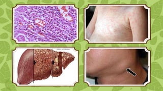 Prominent
eosinophilia

Exanthema

Hepatitis

Lymphadenopathy
21

 