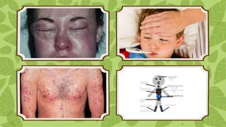 Facial swelling

Fever

Generalized
edema

Multi-organ
failure
22

 