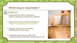Which drug is responsible ?
Patch test
• helps identify which substances
may be causing a reaction in a patient.
• A patch test relies on the principle of
a type IV hypersensitivity reaction.
• Allergic substance will exhibit
inflammation in the skin
• Useful for detecting an ADR with
carbamazepine and other drugs but not all.
28

 