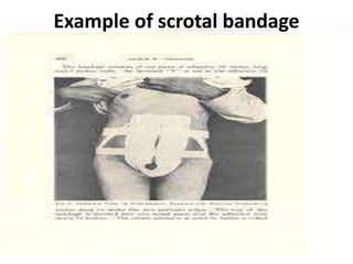 Example of scrotal bandage
 