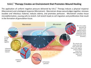 V.A.C.® Therapy Creates an Environment that Promotes Wound Healing
3) Reduces
edema
1) Draws
wound
edges
together
2) Removes
infectious
material
4) Promotes
perfusion
6) In vitro studies
show that cell
stretch under
negative pressure
stimulates cellular
activity that results
in granulation tissue
formation 2
5) In vitro/in vivo
studies show that
foam contact with
tissue under negative
pressure creates
tissue micro-
deformation that
leads to cell
stretch1,3
The application of uniform negative pressure delivered by V.A.C.® Therapy induces a physical response
(Macrostrain) and a biological response (Microstrain). Macrostrain draws wound edges together, removes
exudate and infectious material, reduces edema, and promotes perfusion. Microstrain creates tissue
microdeformation, causing cells to stretch. Cell stretch leads to cell migration and proliferation that result
in the formation of granulation tissue.
 