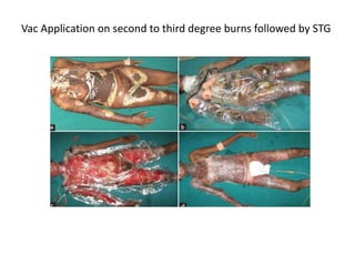 Vac Application on second to third degree burns followed by STG
 