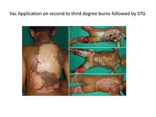 Vac Application on second to third degree burns followed by STG
 