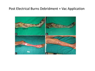 Post Electrical Burns Debridment + Vac Application
 