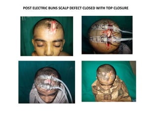 POST ELECTRIC BUNS SCALP DEFECT CLOSED WITH TOP CLOSURE
 