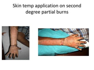 Skin temp application on second
degree partial burns
 