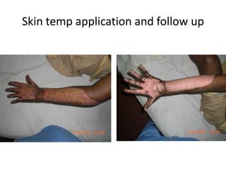 Skin temp application and follow up
 