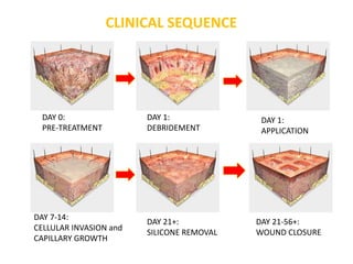 CLINICAL SEQUENCE
DAY 0:
PRE-TREATMENT
DAY 7-14:
CELLULAR INVASION and
CAPILLARY GROWTH
DAY 21+:
SILICONE REMOVAL
DAY 1:
DEBRIDEMENT
DAY 1:
APPLICATION
DAY 21-56+:
WOUND CLOSURE
 