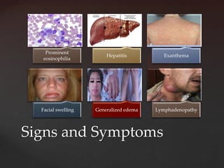 Prominent
                        Hepatitis          Exanthema
   eosinophilia




  Facial swelling   Generalized edema   Lymphadenopathy




Signs and Symptoms
 
